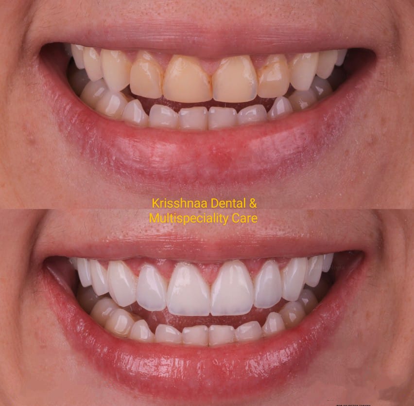 Are There Alternatives To Dental Veneers